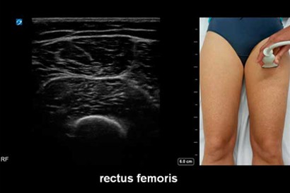 Musculosketal Ultrasound